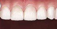 Dental Bridge Implants