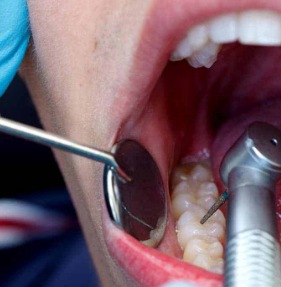 Teeth Extraction By An Oral Surgeon Dentist